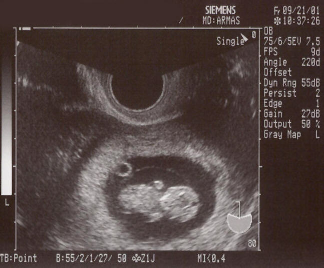 OB_1_Normal_Embryo_4